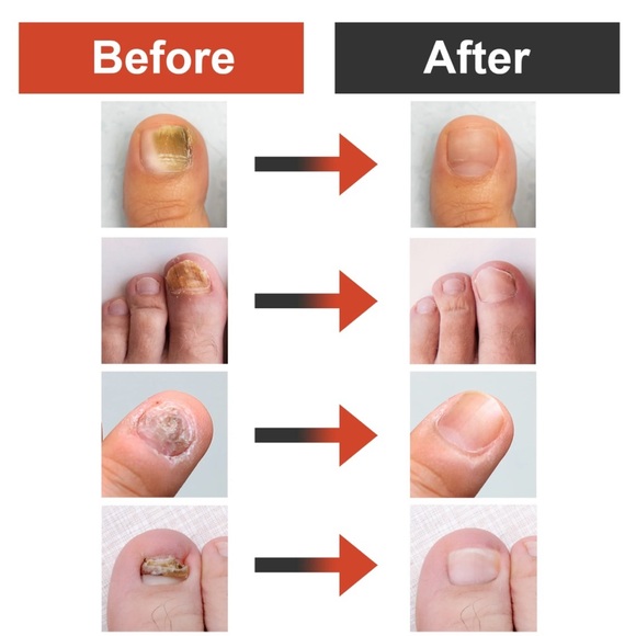 🦶 - BRITE NOW TOENAIL RENEWER 🦶 - Picture 3 of 4